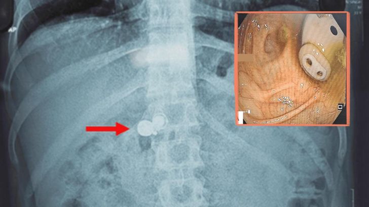 Seorang Pria tak Sengaja Telan Earbud, Bunyinya Muncul dalam Perutnya